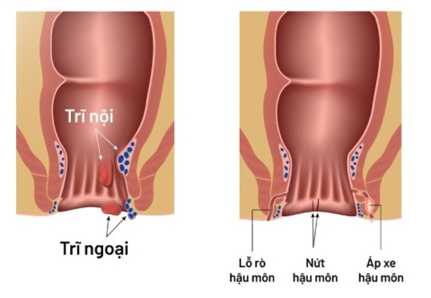 Phân biệt giữa bệnh trĩ và các bệnh lý như nứt kẽ hậu môn hay áp xe hậu môn